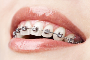 teeth-w-braces